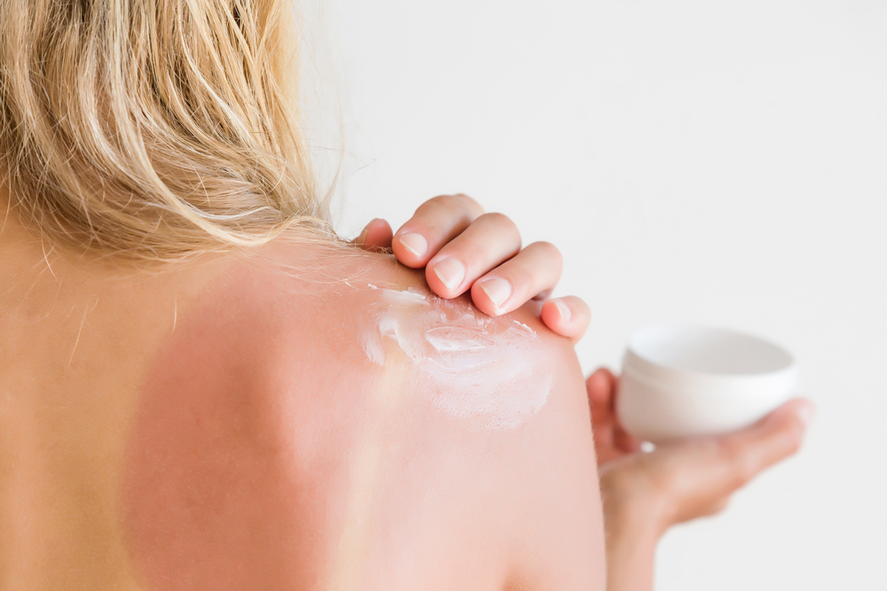 woman applying lotion to sunburned shoulder